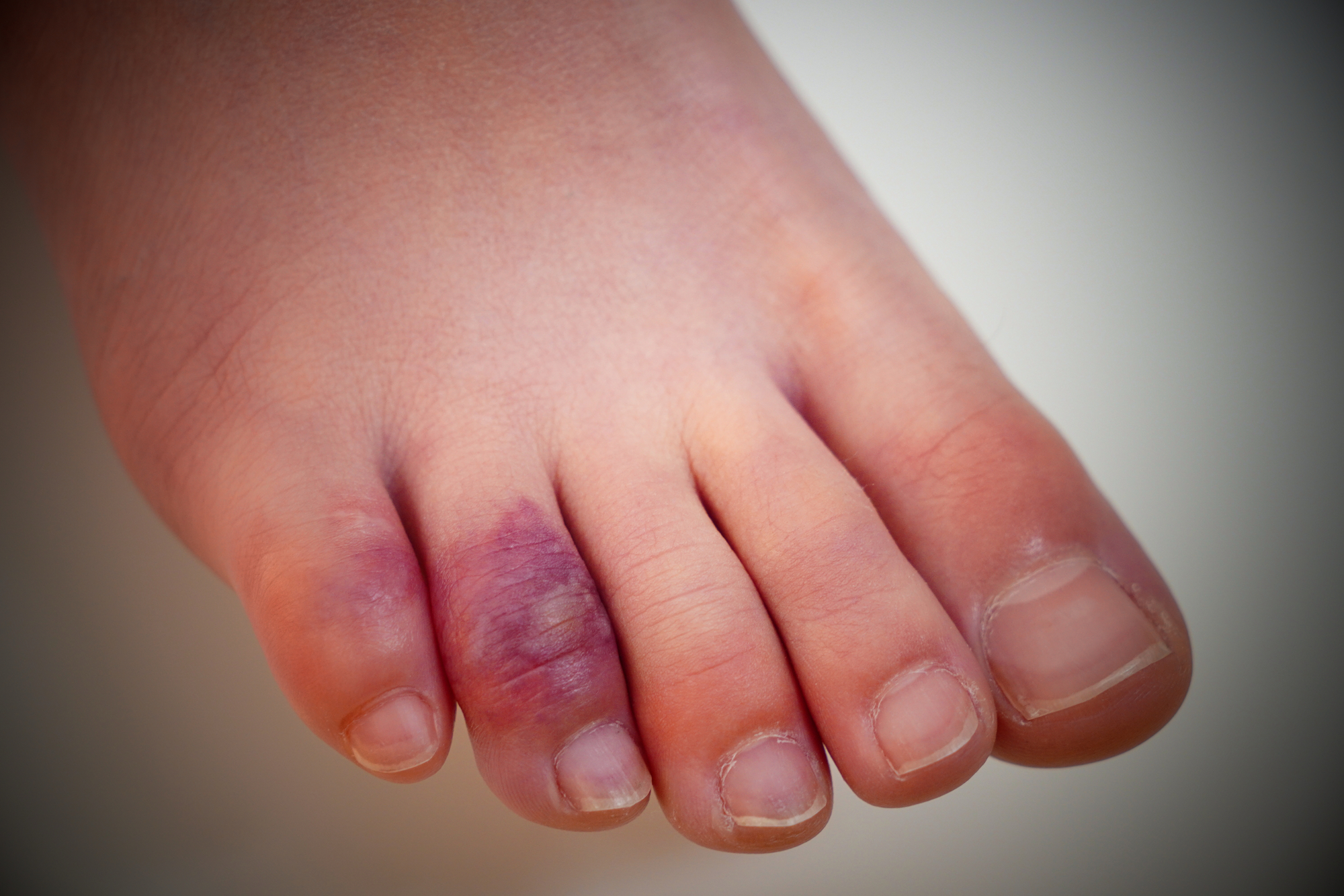 足指の後遺障害について